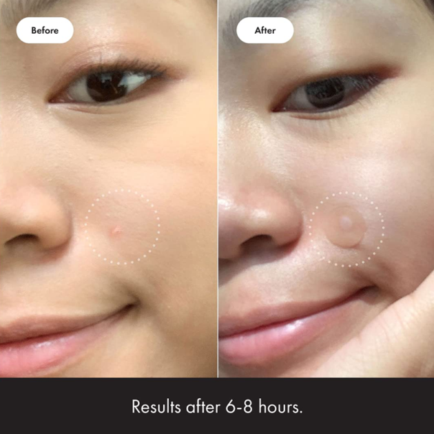 Hydrocolloid acne patch（36 Count） - Image 4